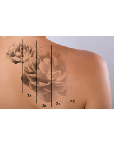 Лазерно премахване на татуировки и перманентен грим