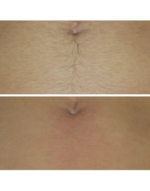 Епилация на линия алба за мъже Епилация на линия алба за мъже