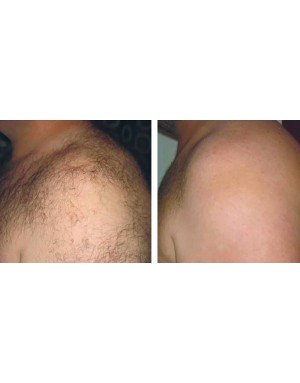 Епилация на рамене за мъже Епилация на рамене за мъже