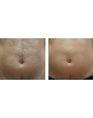 Епилация на корем за мъже Епилация на корем за мъже