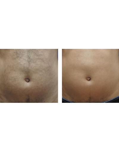 Епилация на корем за мъже