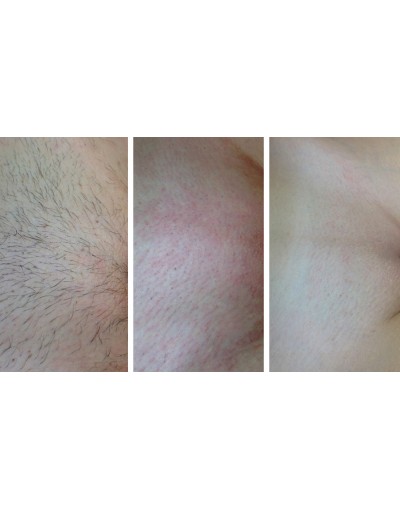 Епилация на интимна зона за жени