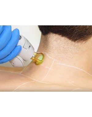 Епилация на врат за мъже