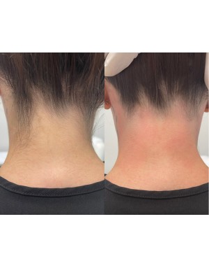 Епилация на врат за жени Епилация на врат за жени