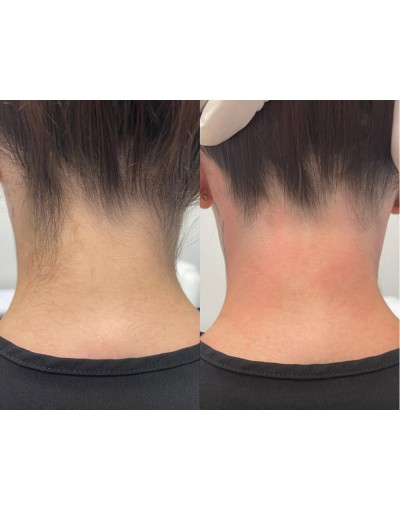 Епилация на врат за жени