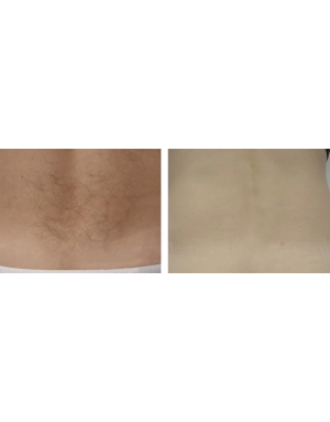 Епилация на кръста за мъже Епилация на кръста за мъже