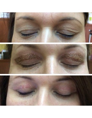 Неоперативна Блефаропластика  (Блефароплазма) Неоперативна Блефаропластика  (Блефароплазма)