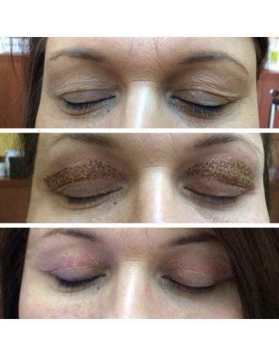 Неоперативна Блефаропластика  (Блефароплазма)