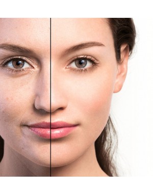 Лазерно подмладяване / Skin Rejuvenation