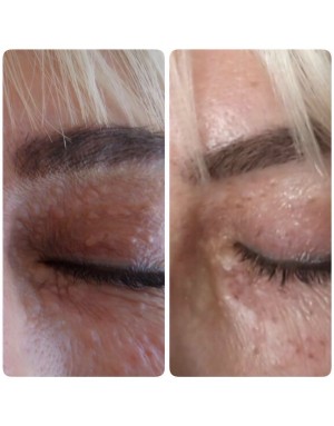 Ксантелазмa Ксантелазмa