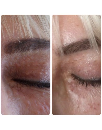 Ксантелазмa