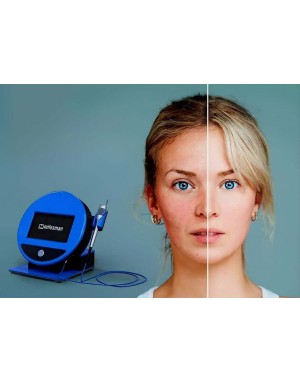 Дълбоко лазерно почистване без обработка на пъпки