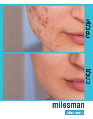 Лечение на акне с обработка на цяло лице