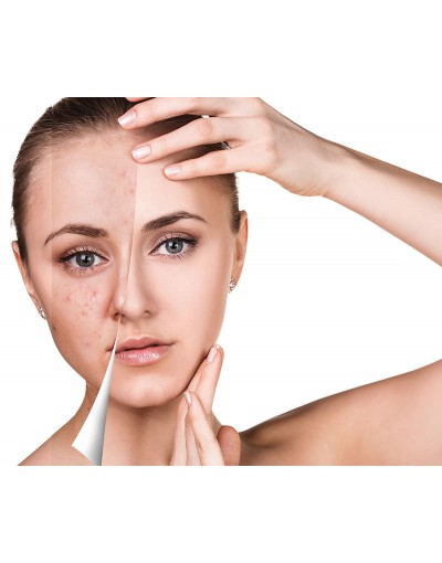 Терапия за проблемна кожа (акне), 60 мин.