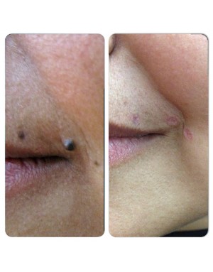 Премахване на фиброми и папиломи Премахване на фиброми и папиломи