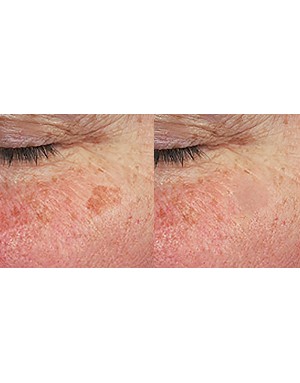 Премахване на лентиго Премахване на лентиго