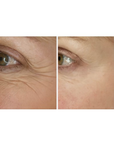 Премахване на фини бръчки около очите  