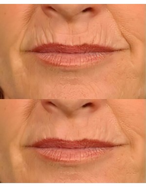 Премахване на бръчки "баркод" и състаряване около устата Премахване на бръчки "баркод" и състаряване около устата