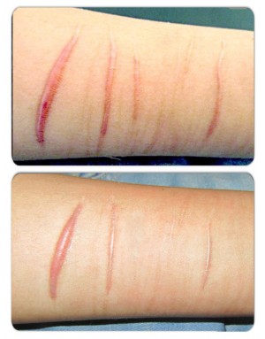 Премахване на белези и келоиди Премахване на белези и келоиди