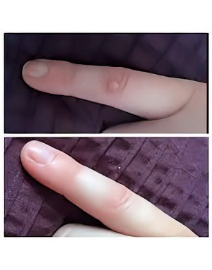 Премахване на брадавици Премахване на брадавици