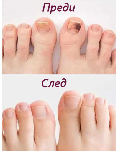 Лазерно лечение на  гъбички под ноктите